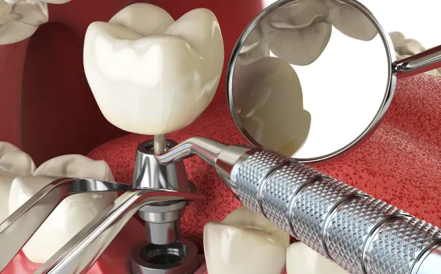Diş implantları
